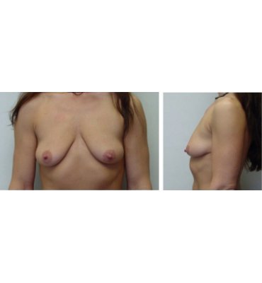 Breast Lift Without Scars Before